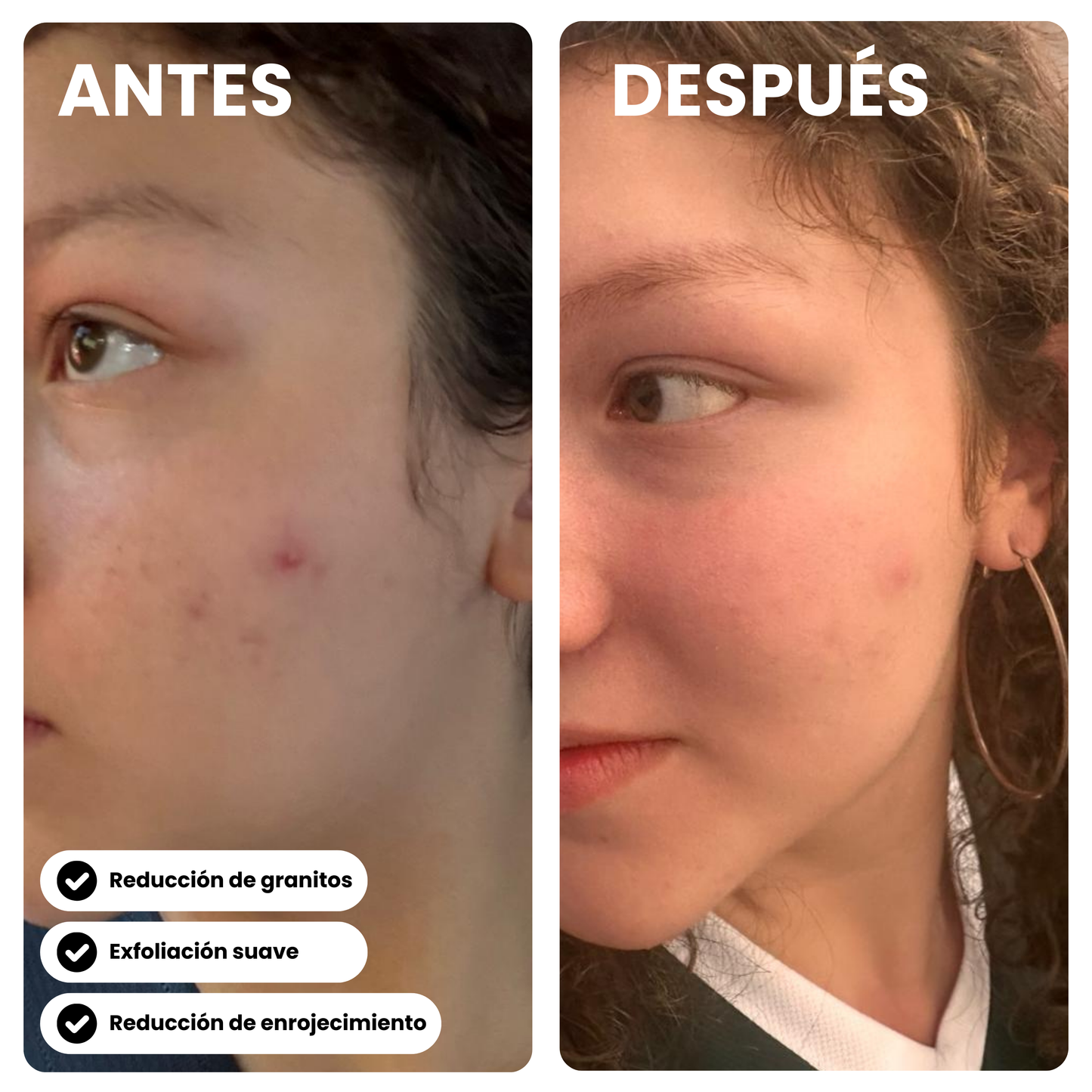 Jabón Facial Espuma con Azufre & Ácido Salicílico